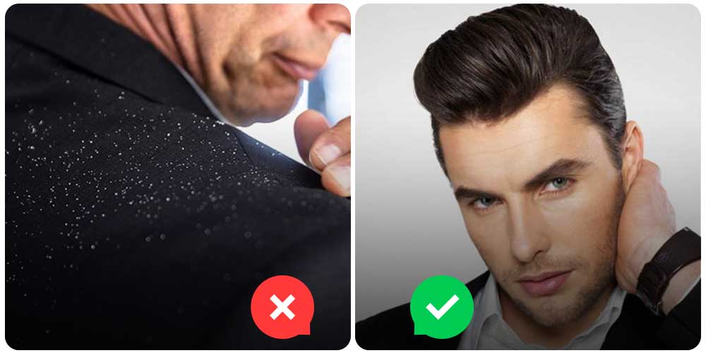 القشرة عند الرجال