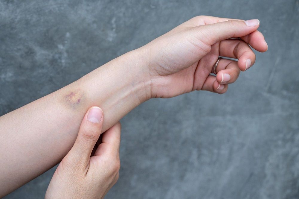 الكدمات على الجسم