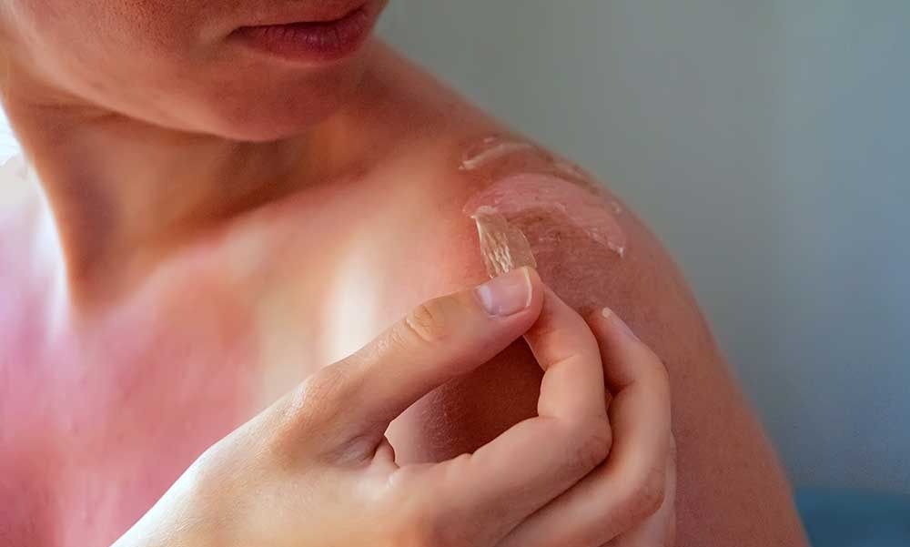 علاج حروق الشمس