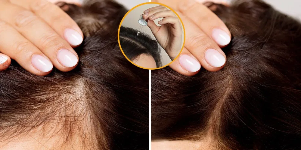 ملء فراغات الشعر من الأمام