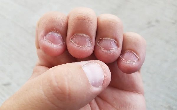 التخلص من قرقضة الأظافر