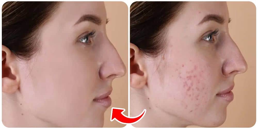 أفضل مشروب لعلاج حب الشباب