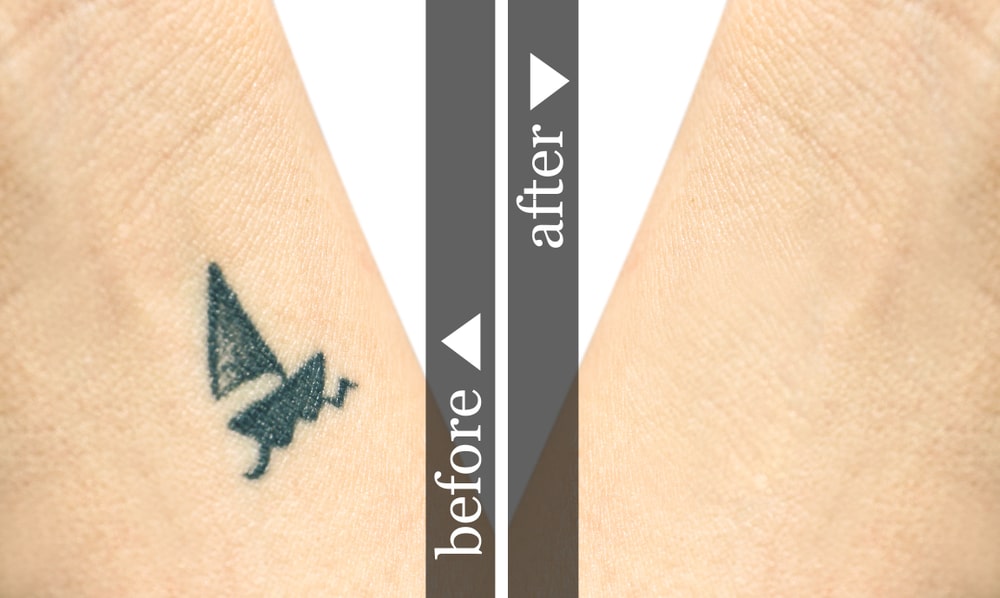 طريقة إزالة التاتو من الجسم