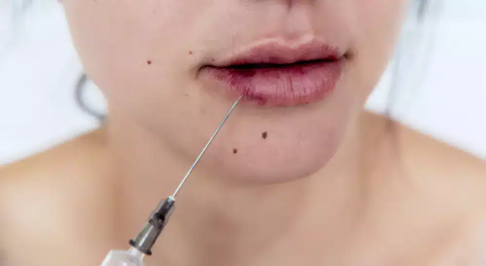 متى يذوب الفيلر بعد الحقن